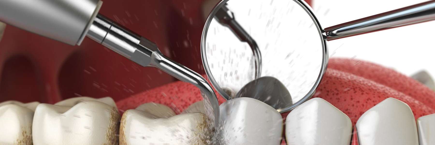 Image of mouth getting cleaned in palos heights, IL