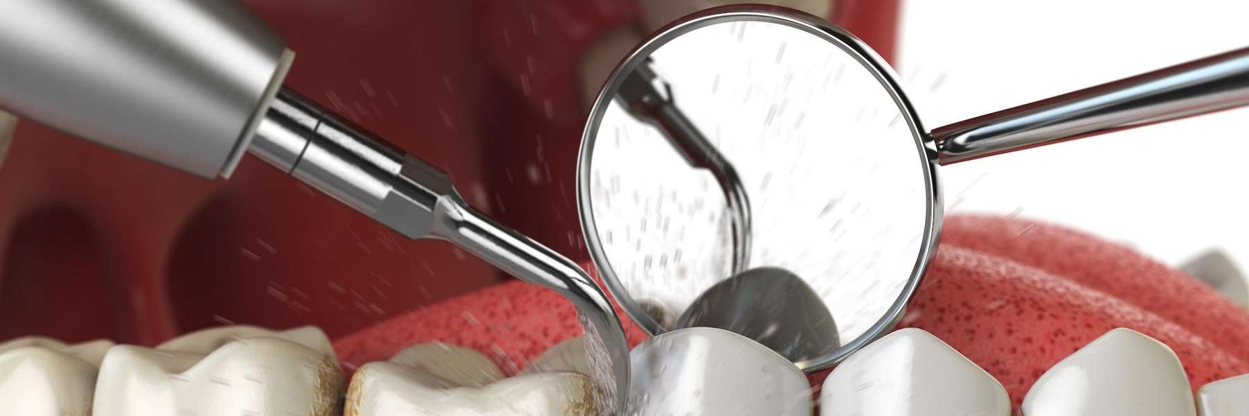 Digital image of a mouth being cleaned, palos heights il