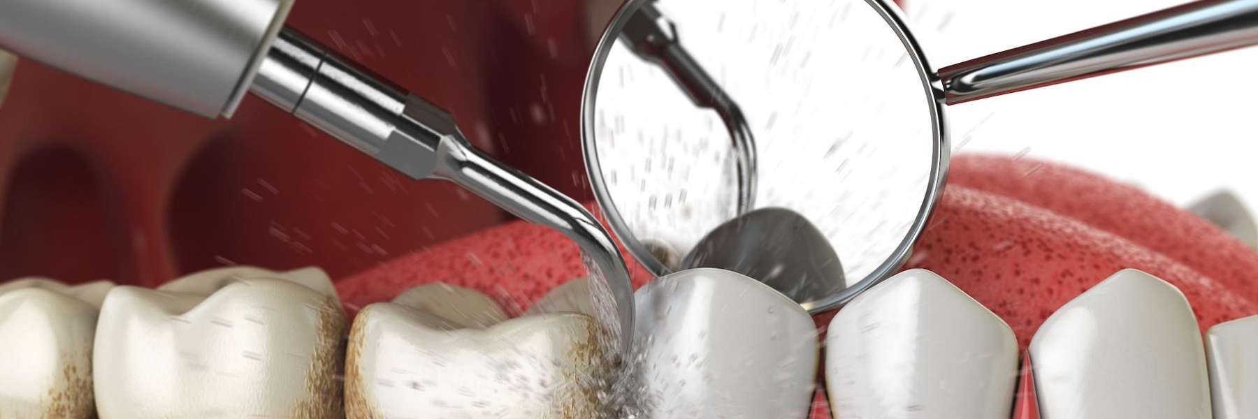 Image of teeth getting cleaned in palos heights, IL