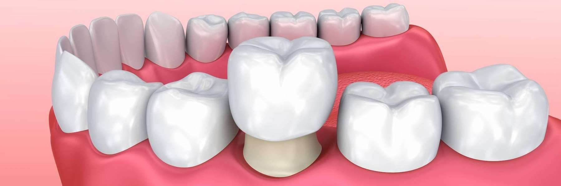 A crown being placed on a tooth model, palos heights il