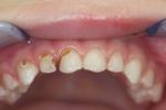 Pediatric-Restorative-Dentistry-Before-Image